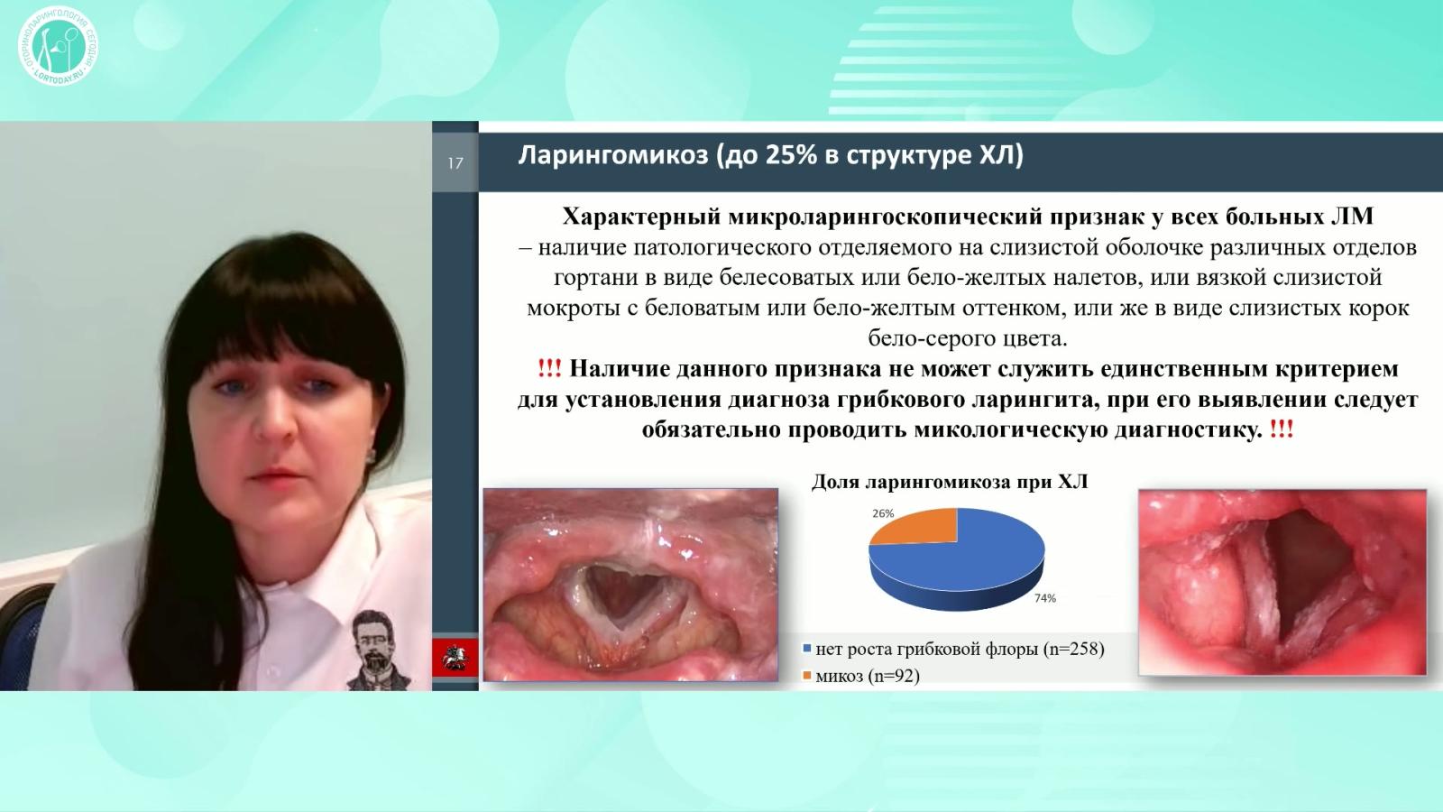 Курбанова Д.И. - Хронический гиперпластический ларингит