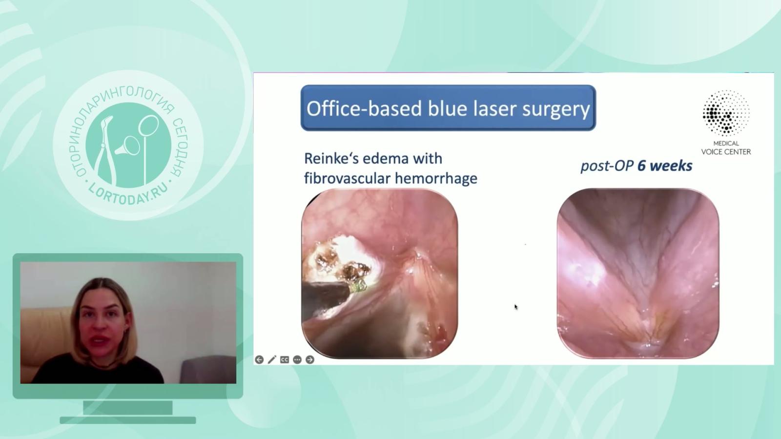 Будейкина Л.С. - Офисная хирургия гортани. Часть 2.