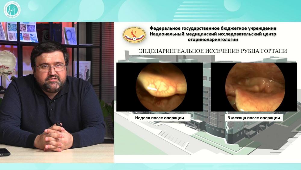 Гусейнов И.Г. - Хирургическое лечение стеноза передней комиссуры гортани